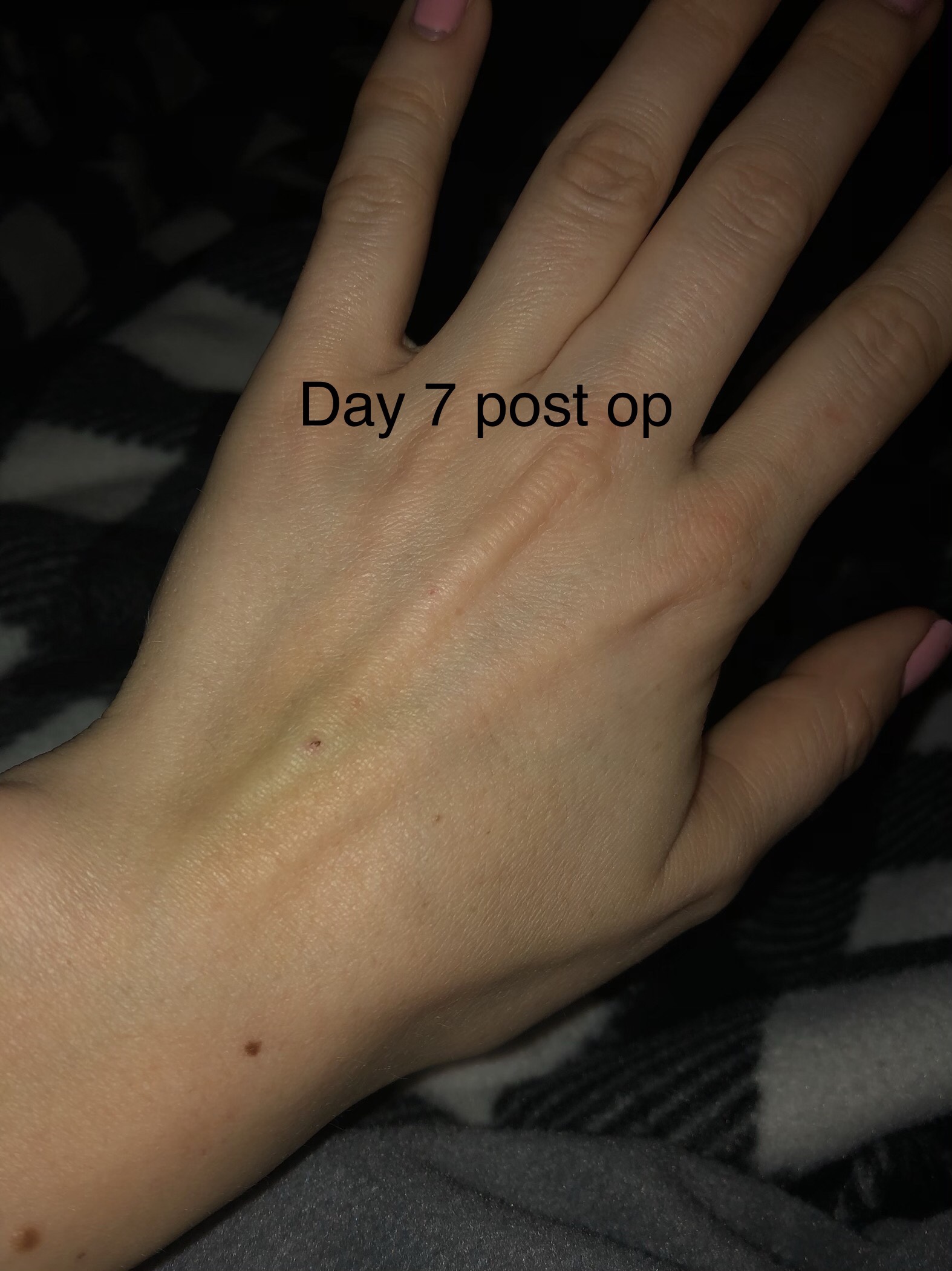 The bruz went down by the feeling of the damaged nurse stayed with me for about 2 months and inability to make a full first because of pain and the sensation of electricity shooting through my whole entire hand. 